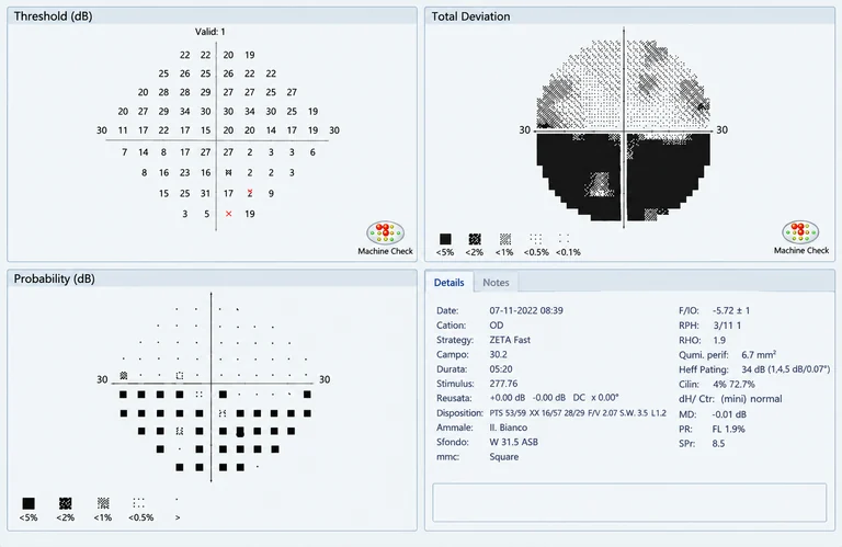 Illustrazione di un campo visivo computerizzato con mappe di sensibilità e dati di esempio