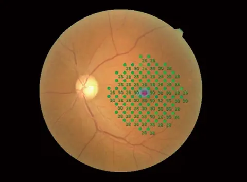 Illustrazione della valutazione della sensibilità retinica con microperimetria
