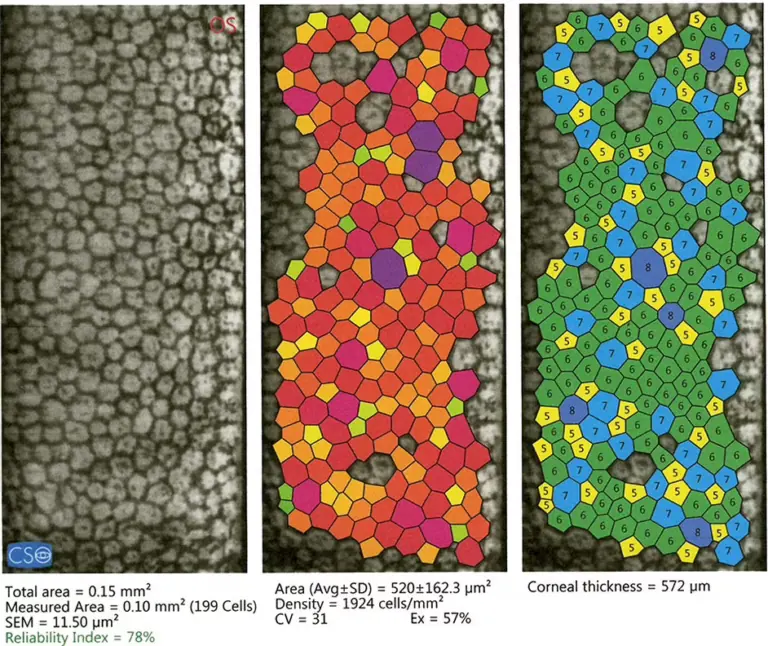 Mosaico delle cellule endoteliali corneali con analisi della densità e della morfologia