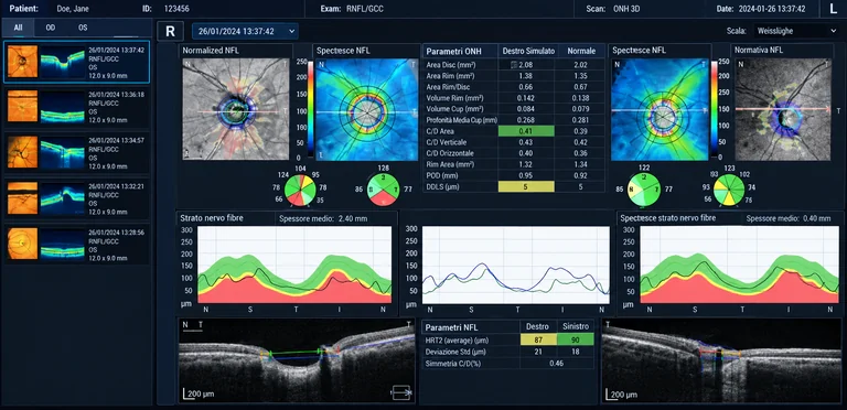 Illustrazione di un’analisi OCT delle fibre nervose retiniche e del nervo ottico, con dati di esempio