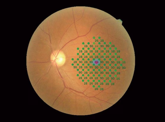 Mappa di microperimetria per riabilitazione visiva